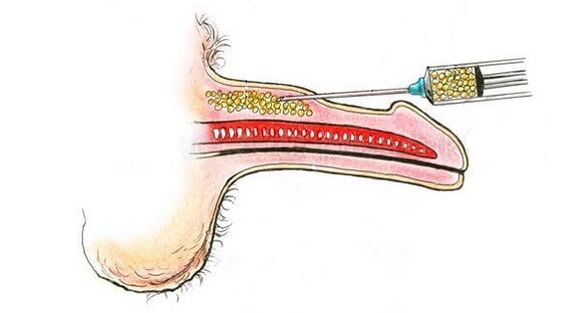 Injekce kyseliny hyaluronové do hlavně člena, aby se zvýšila